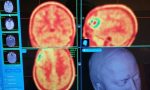 Tumori cerebrali: Firenze e Prato sperimentano nuova tecnica